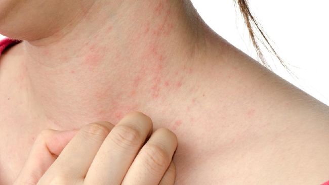 Ruam di kulit bisa terjadi pada siapa saja karena sejumlah penyebab. Terdapat penyebab ruam kulit yang umum terjadi.