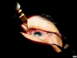 Mengenal Katarak dan Trik Jaga Kesehatan Mata