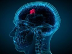 Waspada Tumor Otak, Ketahui Cara Penanganan yang Efektif